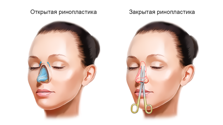 Ринопластика в Херсоне: цена и как проходит операция?